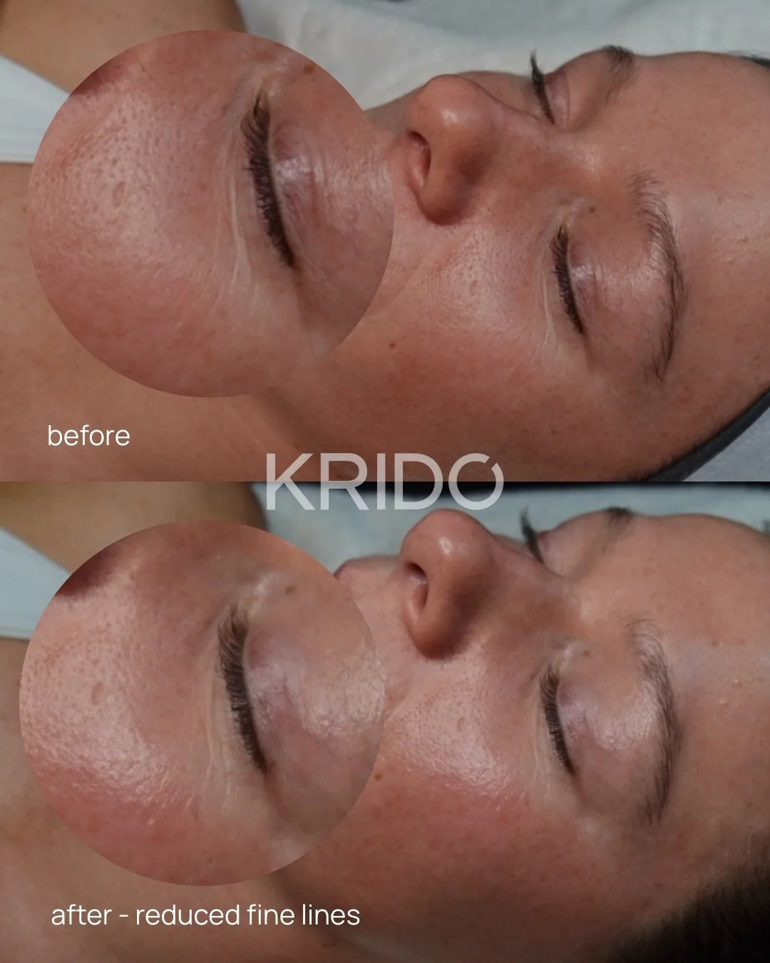 Close-up of a client’s eye area before and after a facial at KRIDO Wellness, labelled reduced fine lines