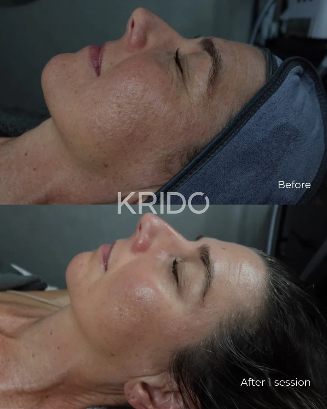 Profile of a client before and after a facial at KRIDO Wellness, showing a brighter complexion