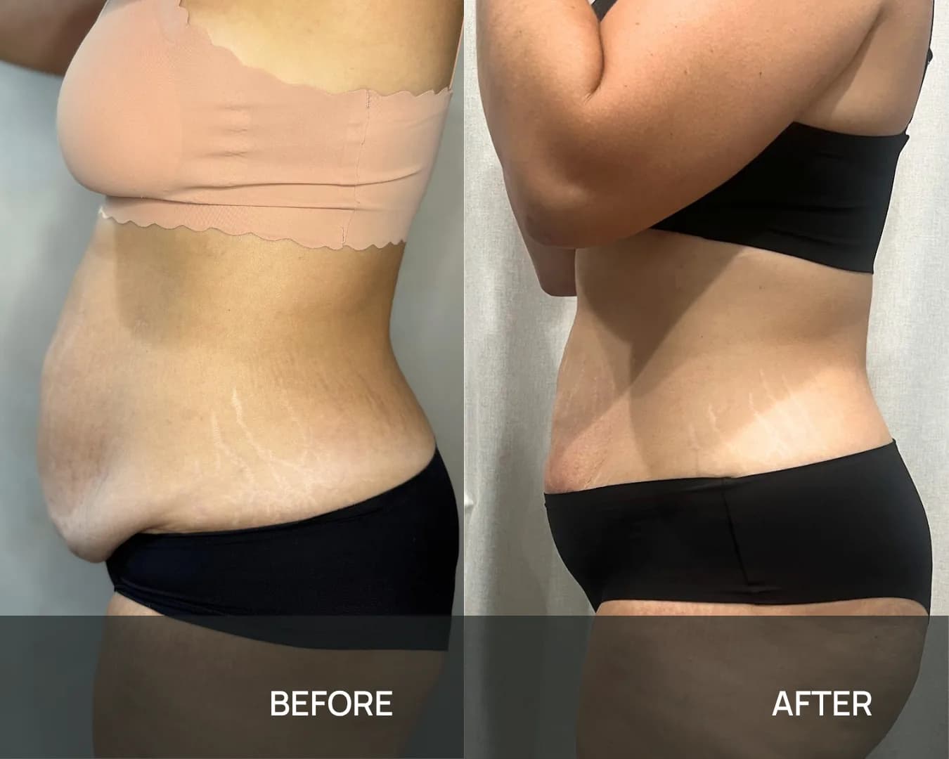 Side view of a client’s abdomen and waist before and after cryo body sculpting at KRIDO Wellness, the two frames labelled BEFORE and AFTER