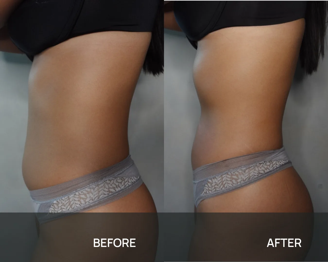 Side profile of a client’s abdomen and waist before and after cryo body sculpting at KRIDO Wellness, the two frames labelled BEFORE and AFTER