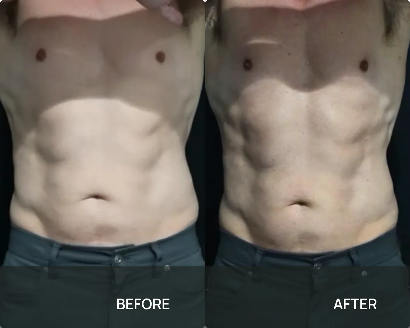 Front view of a male client’s abdomen before and after cryo body sculpting at KRIDO Wellness, with more visible muscle definition in the after frame