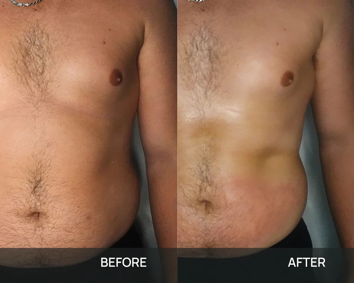 Front view of a male client’s chest and abdomen before and after cryo body sculpting at KRIDO Wellness, the two frames labelled BEFORE and AFTER