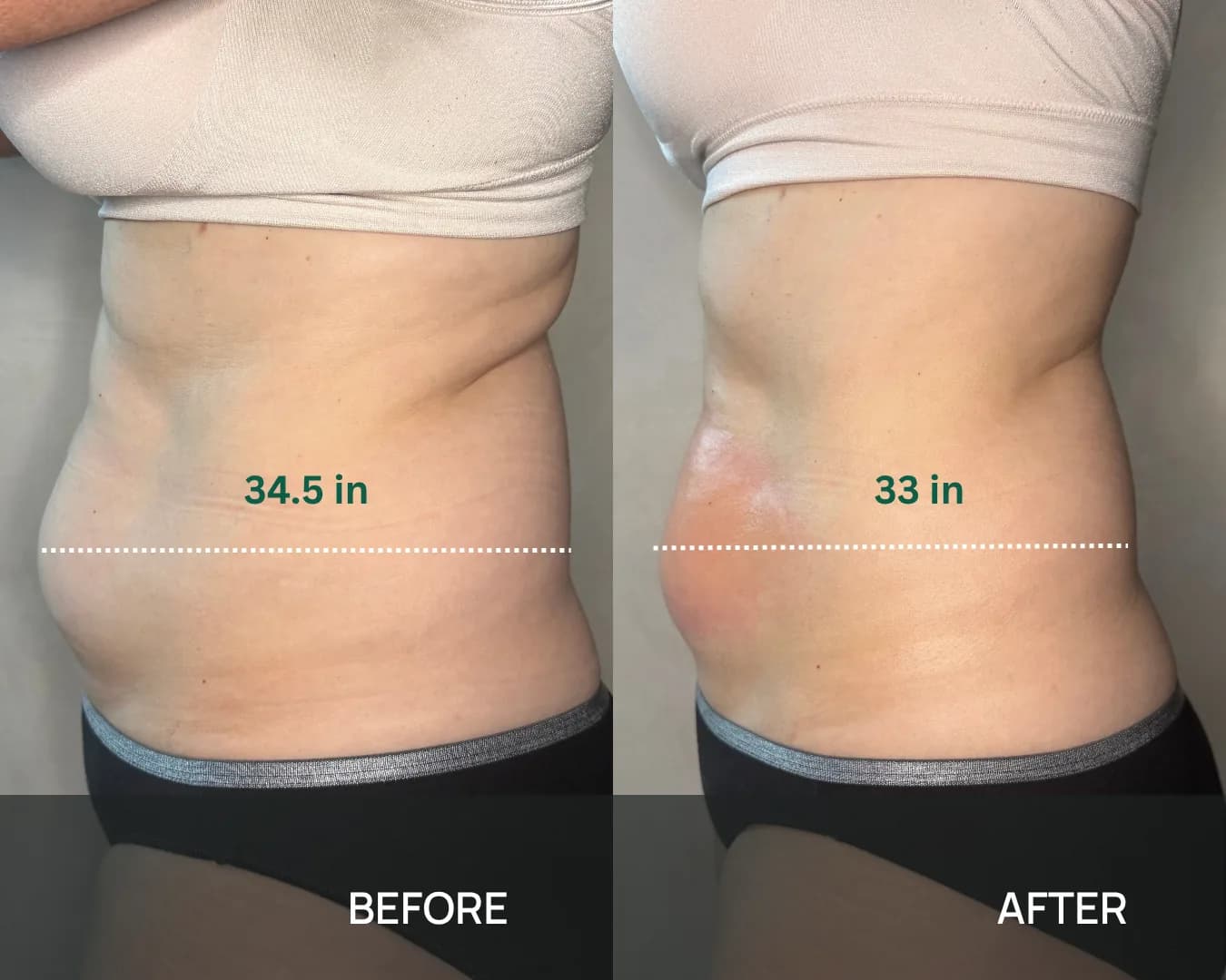 Side view of a client’s waist before and after cryo body sculpting at KRIDO Wellness, labelled by the studio with a waist measurement of 34.5 inches before and 33 inches after