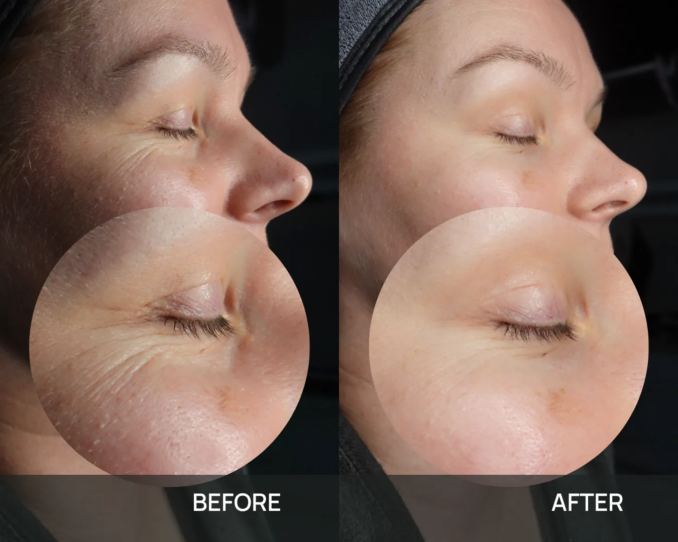 A client’s eye area before and after cryo face sculpting at KRIDO Wellness