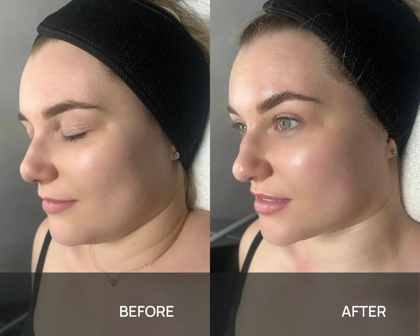 Side view of a client’s lower face and neck before and after cryo face sculpting at KRIDO Wellness