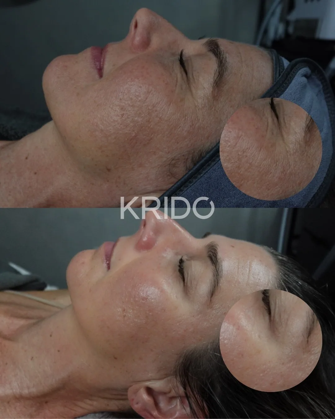 Before and after a KRIDO Wellness anti-aging facial showing smoother, brighter skin