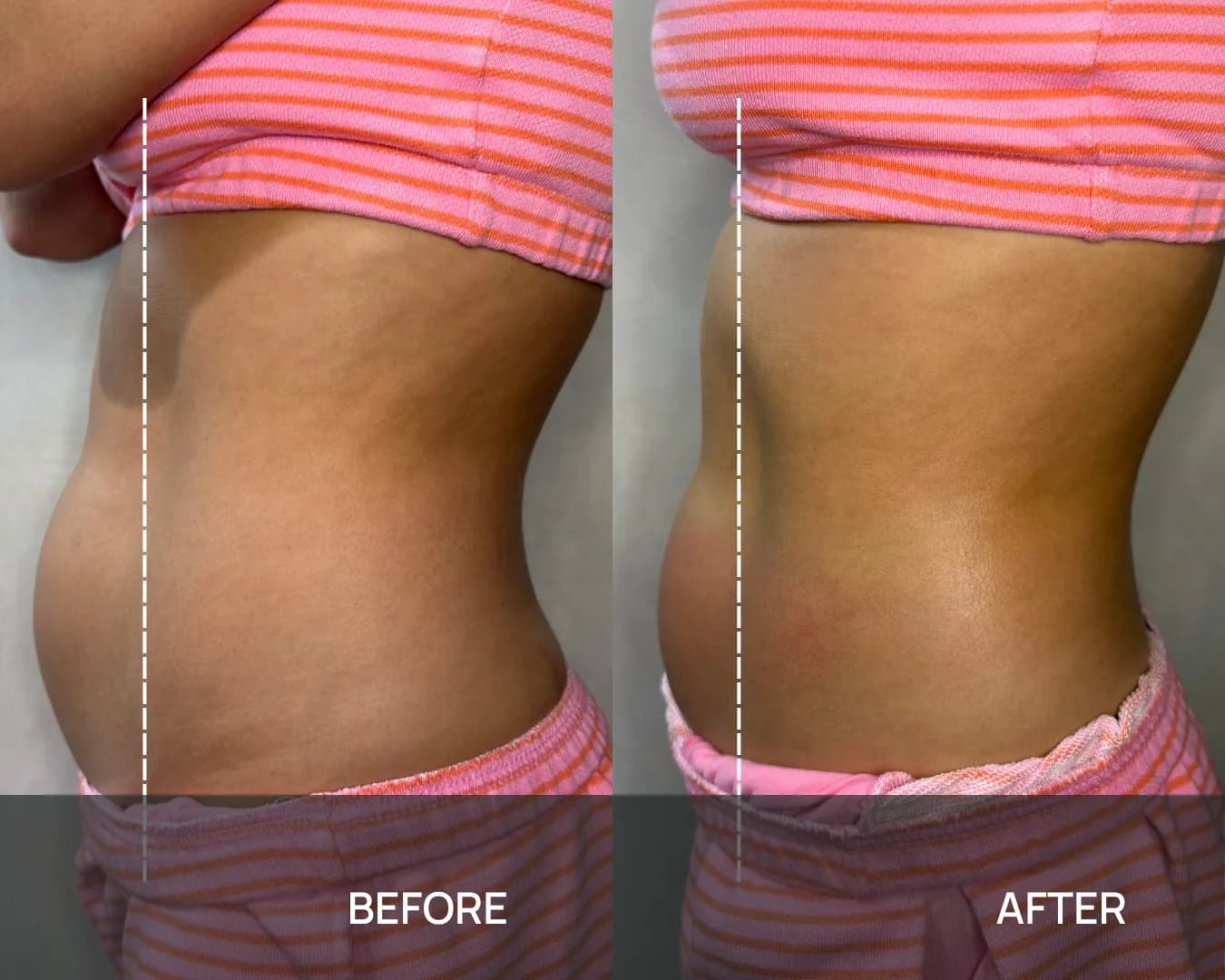 Side view of a client’s abdomen before and after cryo body sculpting at KRIDO Wellness