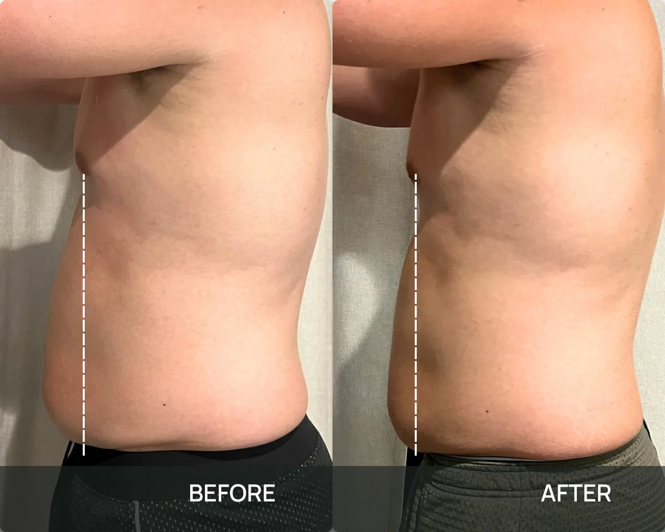 Side view of a male client’s abdomen and flank before and after cryo body sculpting at KRIDO Wellness