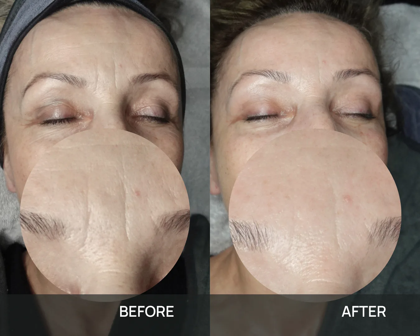 A client’s forehead before and after cryo face sculpting at KRIDO Wellness, each frame carrying a magnified inset of the lines between the brows