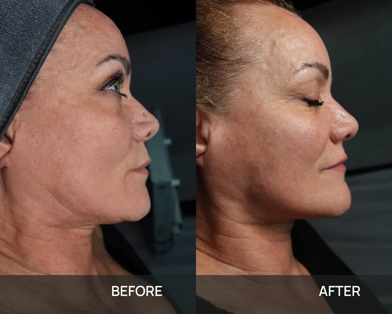 Profile of a client’s cheek, jawline and neck before and after cryo face sculpting at KRIDO Wellness