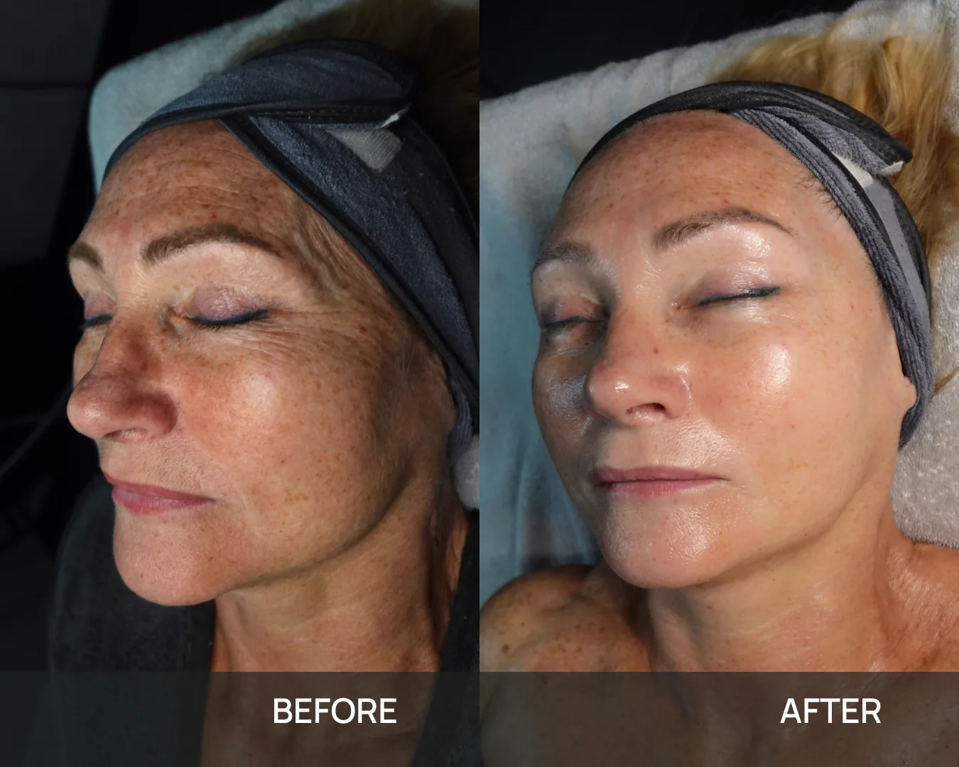 A client’s cheek and jawline before and after cryo face sculpting at KRIDO Wellness