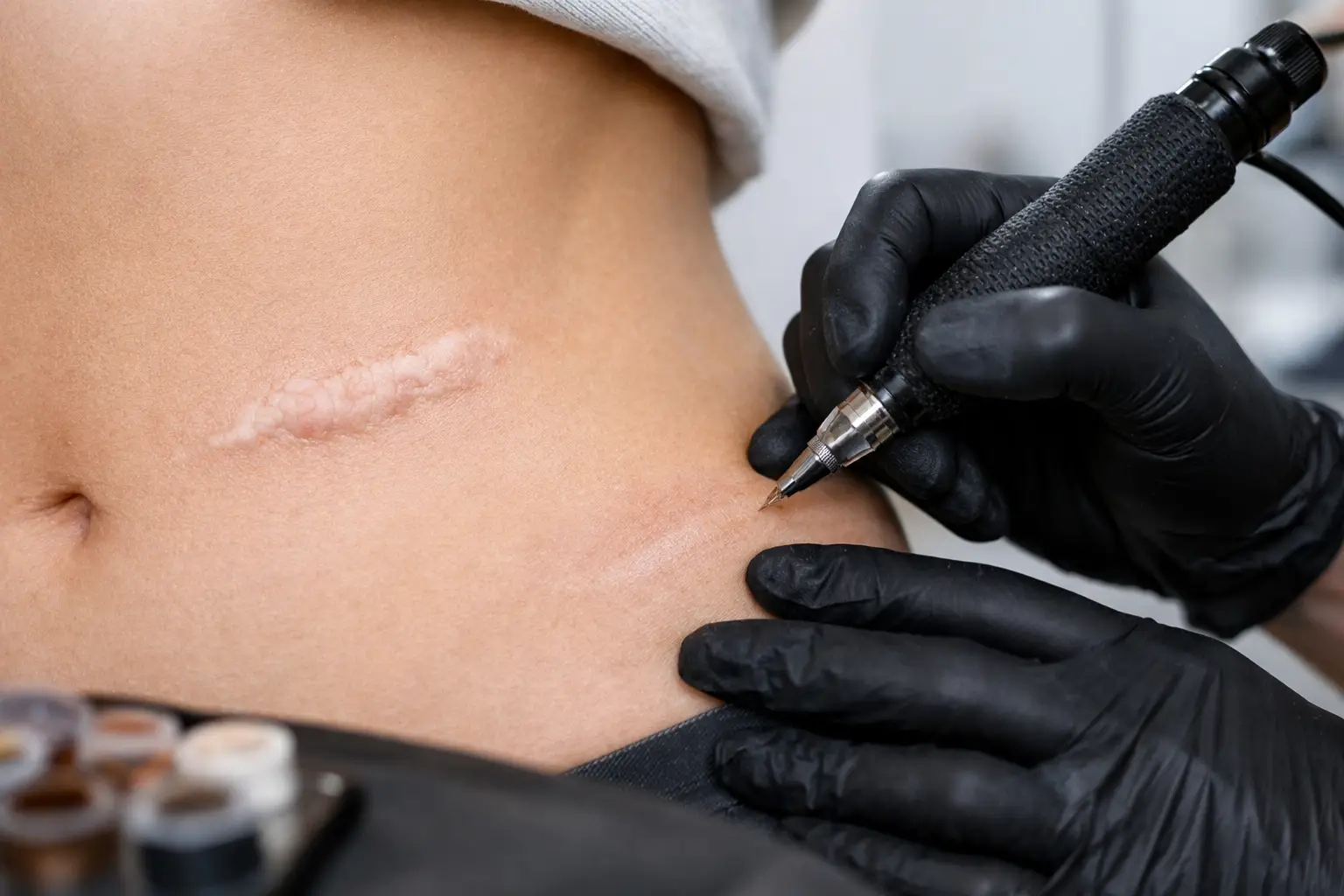 Scar camouflage tattooing on an abdominal scar